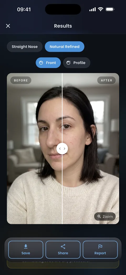 Rhinoplasty result screen in the app